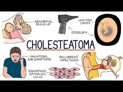 Understanding Cholesteatomas