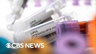 Study finds possible lupus cause, way to reverse disease