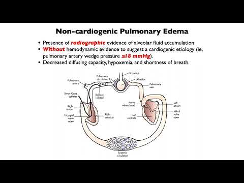 20230411 pulmonary edema and acute lung injury