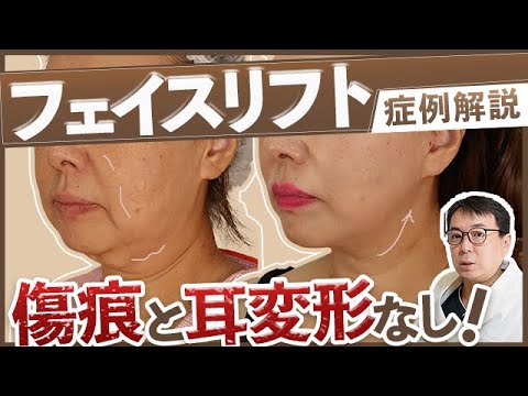 【フェイスリフト】これがプロ！傷痕や細部へのこだわりが徹底すぎる哲先生の技術を徹底解剖！