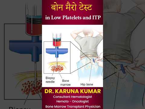 बोन मैरो टेस्ट | Bonemarrow Test in Low Platelets and ITP #bonemarrow #itp #drkarunakumar #platelets