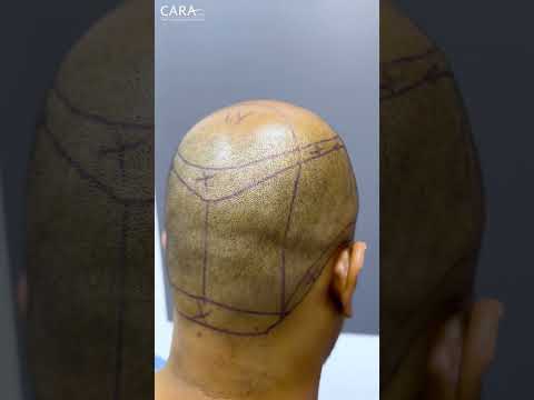 Cara Clinic's REAL Hair Transplant Results That Will SHOCK You!