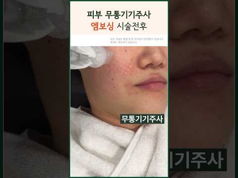 남들 다하는 리쥬란 물광 통증때문에 안하시나요??| 적은 통증과 엠보싱 더마샤인 무통기기주사 #modsclinic #모즈클리닉