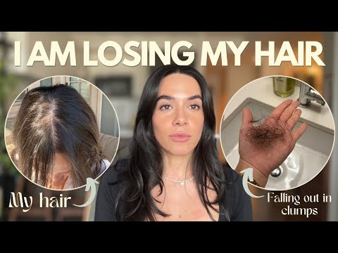 MY HAIR LOSS JOURNEY | Hair Loss as a Woman, Minoxidil, iRestore, Iron Deficiency