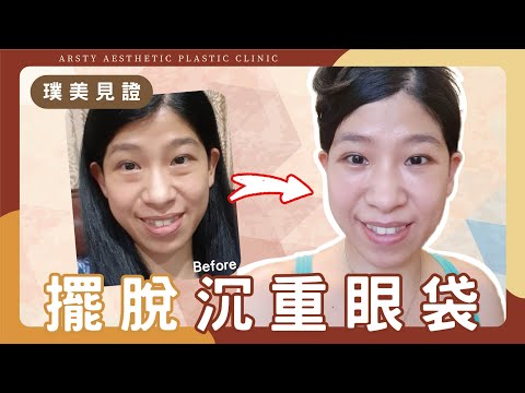 【眼袋手術】擺脫浮腫，找回有神雙眼 | 璞美整形外科醫美診所