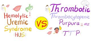 Hemolytic Uremic Syndrome (HUS) vs. Thrombotic Thrombocytopenic purpura (TTP)