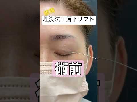 埋没法＋眉下リフトの抜糸時を公開します。ダウンタイムの参考にして下さい☆