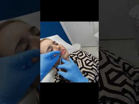 Best Botox Lip Flip Injection Treatment Technique in Plantation, Florida #shorts #botox #lipflip