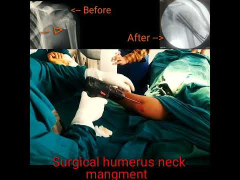 #Surgical humerus neck, #हयूमरस नेक फ्रैक्चर प्रबंधन