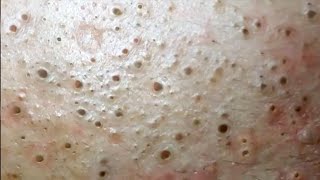 Multiply Blackheads on Forehead - Blackheads Removal