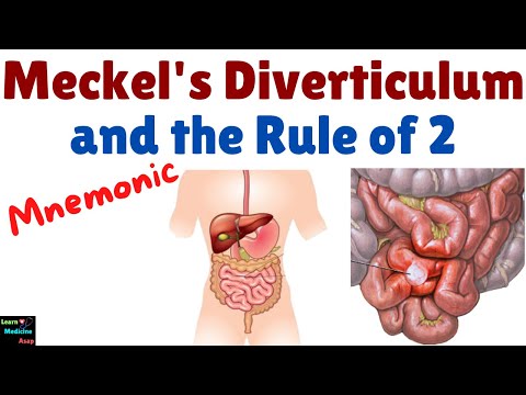 Meckel's Diverticulum and the Rule of 2 – Meckel's Diverticulum Explained