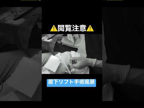 眉下リフトの縫合の様子をご覧下さい。心を込めて丁寧に縫います。