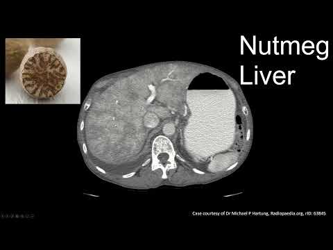 Interpreting CT Abdo: Nutmeg Liver - Passive Congestion, Budd Chiari, and SOS