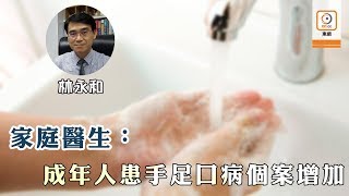 Dr.東：成人也可感染手足口病　照顧孩子要注意自己衞生