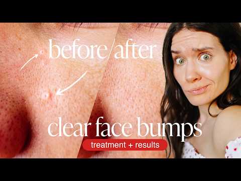 BURNING OFF WARTS AT HOME - Warts Sebaceous Hyperplasia Removal - DIY WART REMOVAL