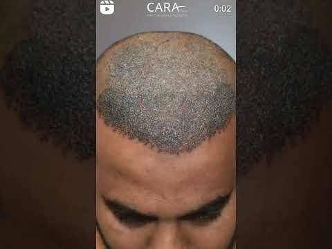 Awesome Sapphire Hair Transplant Results in just 5 months!