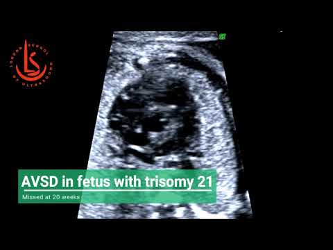 AVSD for fetus with Down's syndrome missed at 20 weeks scan