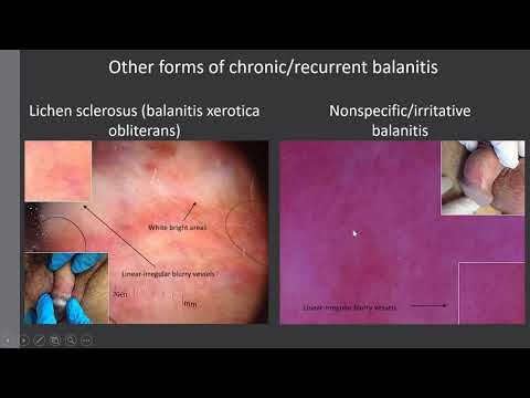 Erythroplasia Queyrat vs Balanitis - Dr. Enzo Enrichetti