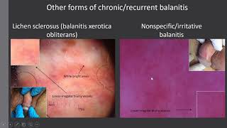 Erythroplasia Queyrat vs Balanitis - Dr. Enzo Enrichetti