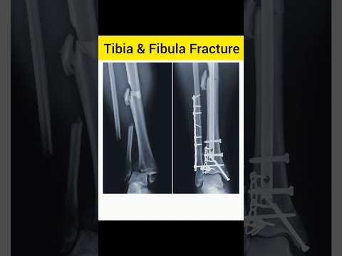 Tibia & Fibula after surgery