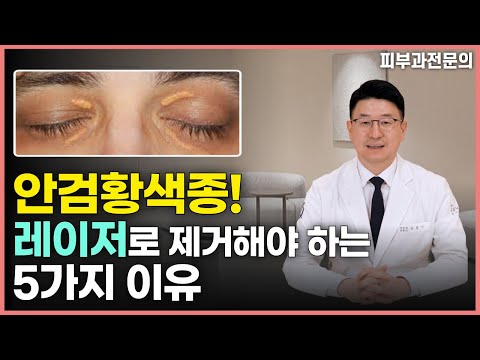 Xanthelasma Palpebrarum Removal: 5 Reasons Why Surgical Removal Should Be Avoided. Opt for Laser!