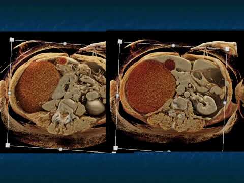 CT of the Large (greater than 4cm) Adrenal Mass: Pearls and Pitfalls - Part 2