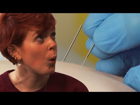 Irish People Try Dry Needling For The First Time