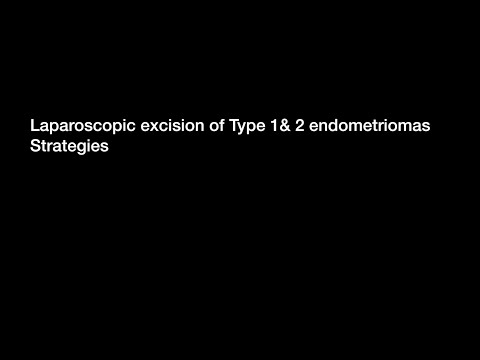 Laparoscopic Endometrioma excision Dr. Rooma Sinha Apollo Hospitals Hyderabad India