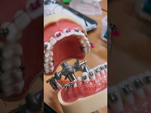 How to add wire, elastic band on teeth? #dentalcare #SJVC #orthodontics #DentalAssistant #shorts