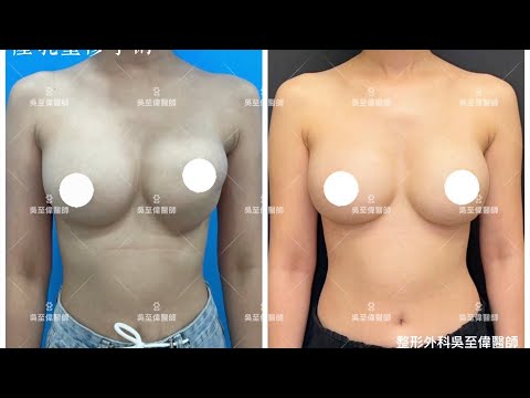 雙層奶變奇蹟胸型✨｜二次隆乳修護術解決莢膜攣縮的故事