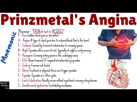 Prinzmetal's Angina Mnemonic - Clinical Features, Risk Factors and Pathophysiology