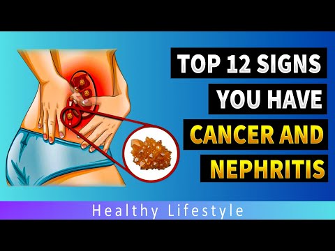 Warning! 12 signs of Kidney Cancer and Kidney Stones | Healthy lifestyle