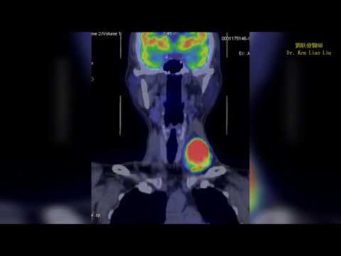 Neck Diffuse Large B Cell Lymphoma 頸部淋巴瘤