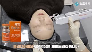 동안피부 필수 ! 콜라겐 부스터 뽀드베베 올리디아 마요 시술 팁 !