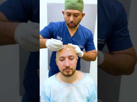 Transform Your Life with Hair Transplant at Cara Clinic