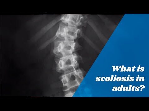 What is scoliosis in adults?