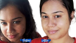 7 Days Challenge Remove Pimples With Natural Products(Hindi)-Pimple Removal At Home-Tips For Pimples