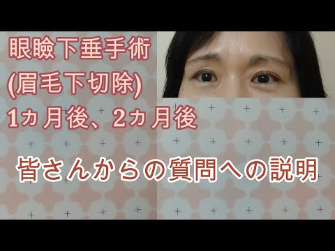 眼瞼下垂(眉毛下切除)手術１ヵ月後２ヵ月後、術式について、手術までの経緯など