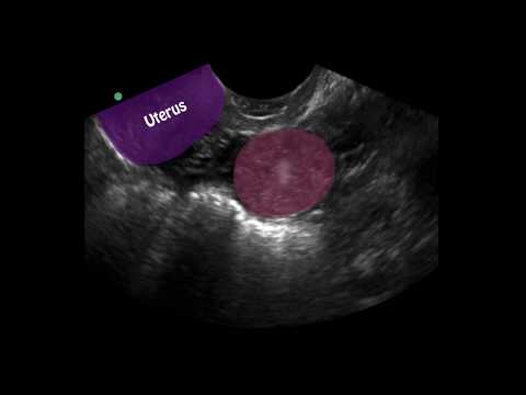 POCUS: 1st Trimester Pregnancy Case 4 - Ectopic Pregnancy