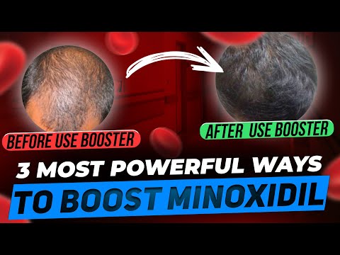 Minoxidil Boosters - 3 Most Powerful Ways to Make Minoxidil MORE Powerful!