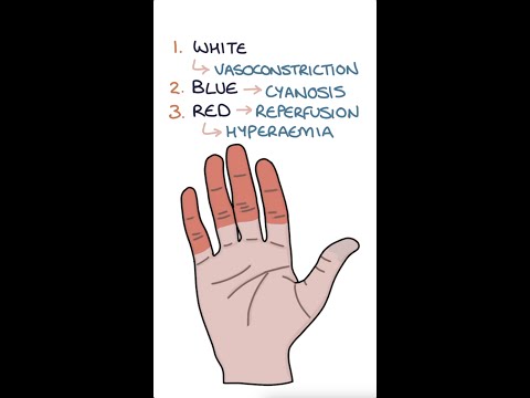 Raynaud's Disease #medicine #rheumatology