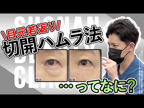 究極の目の下タルミ取り【切開ハムラ法】ってどんな手術？