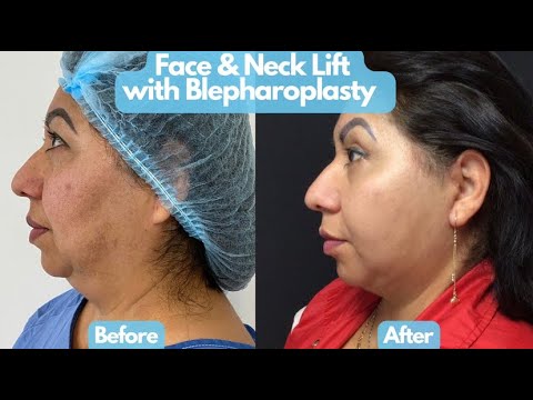 Face & Neck Lift with Blepharoplasty Surgery