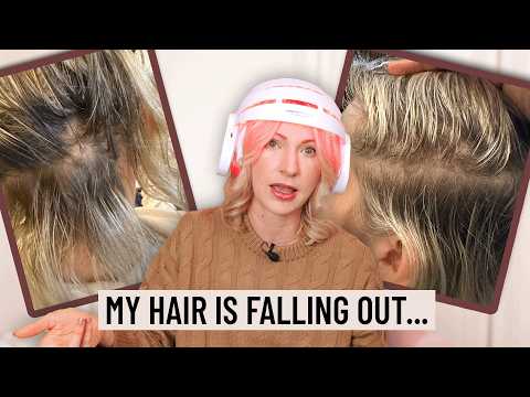 Why I’m Losing My Hair... (+ the Hair Growth Treatments I’m Trying)