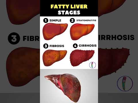 Fatty liver stages | Liver cirrhosis | Liver disaese | Liver detox