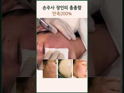 스킨부스터 장인 리쥬란 물광주사 이렇게 해야 효과 볼수 있습니다. | 시술장면 과정 엠보 #modsclinic #모즈클리닉  #리쥬란힐러 #물광주사 #손주사