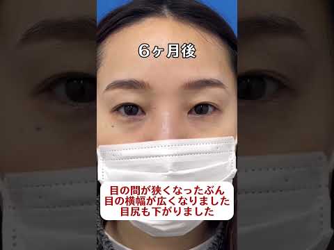 目頭切開、目尻切開、切らないたれ目術で目の横幅を広く優しい目元に　６か月後 #shorts