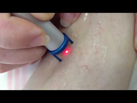 Treatment of Vascular Lesion by Laser - MedArt VariMed System