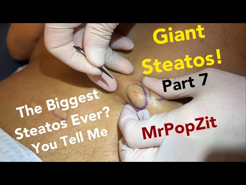 Giant Steatocystomas part 7. She may have the biggest ones ever, you make the call! Drain the butter