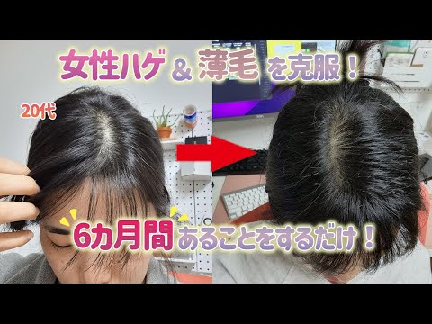 【悩んでる方必見】20代女性ハゲ＆薄毛からの克服ストーリ！育毛成功の秘密も公開！